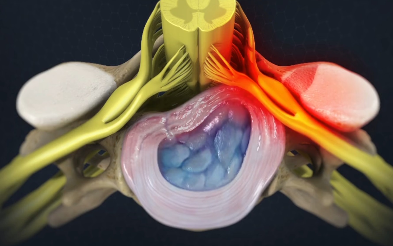 Cervical Radiculopathy 7445