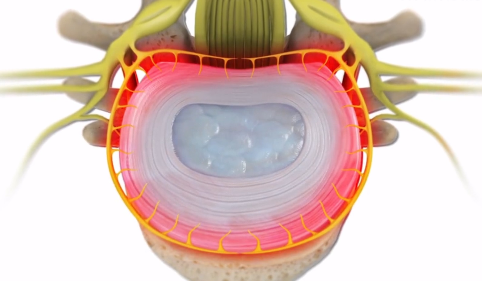 Discogenic Pain