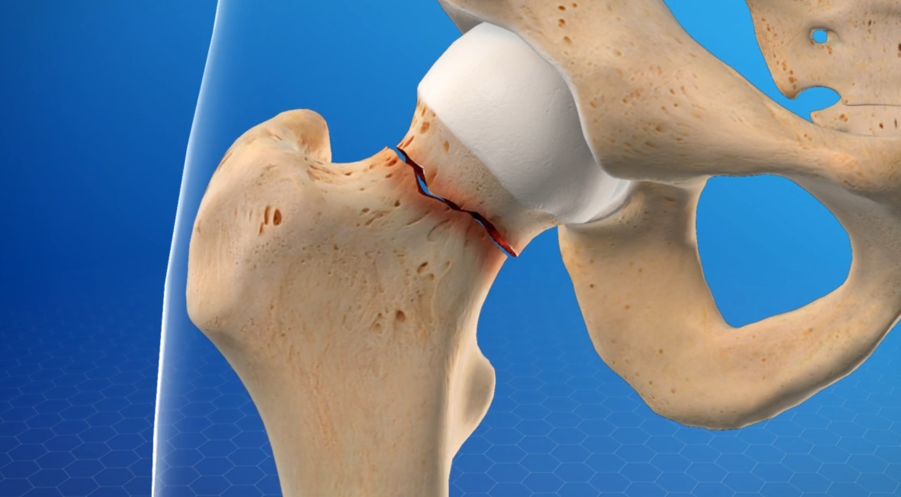 severe-symptoms-of-hip-bursitis