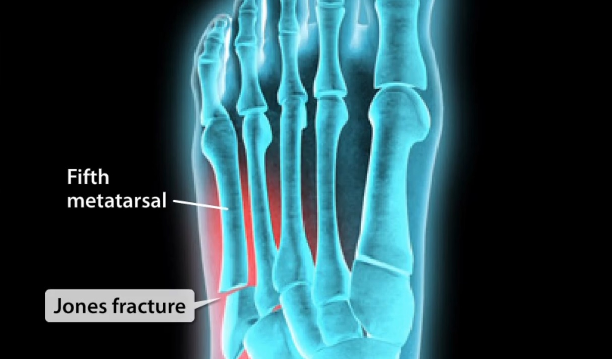 cpt orif 5th metatarsal fracture