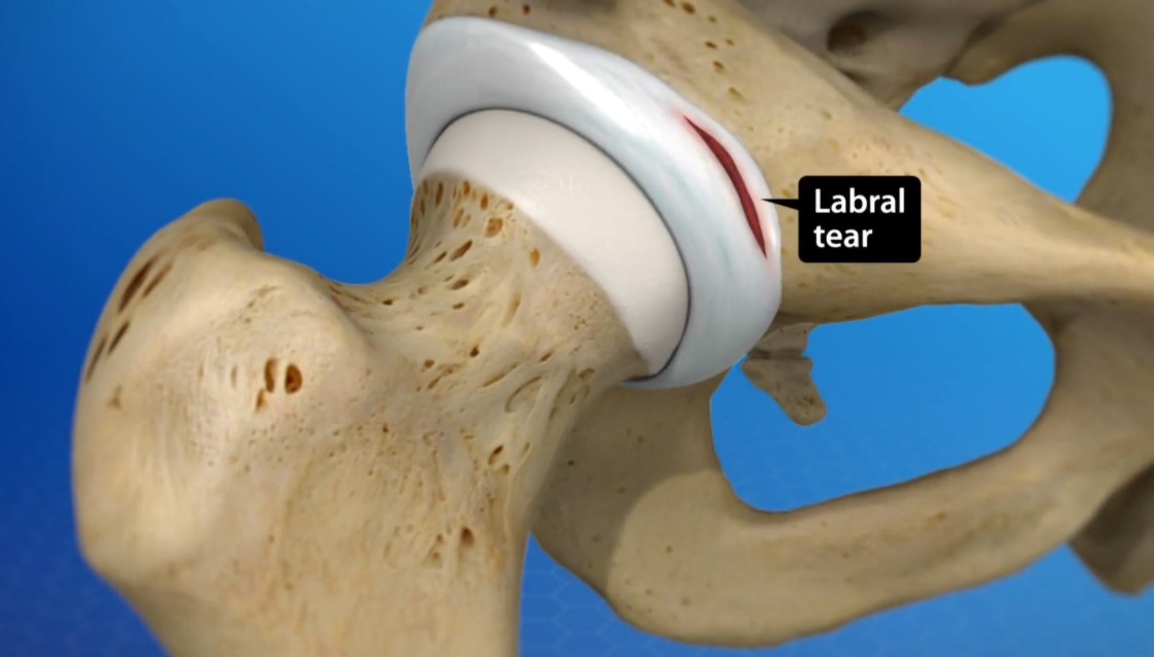 Labral Tear Of The Hip Acetabular Labrum Tear