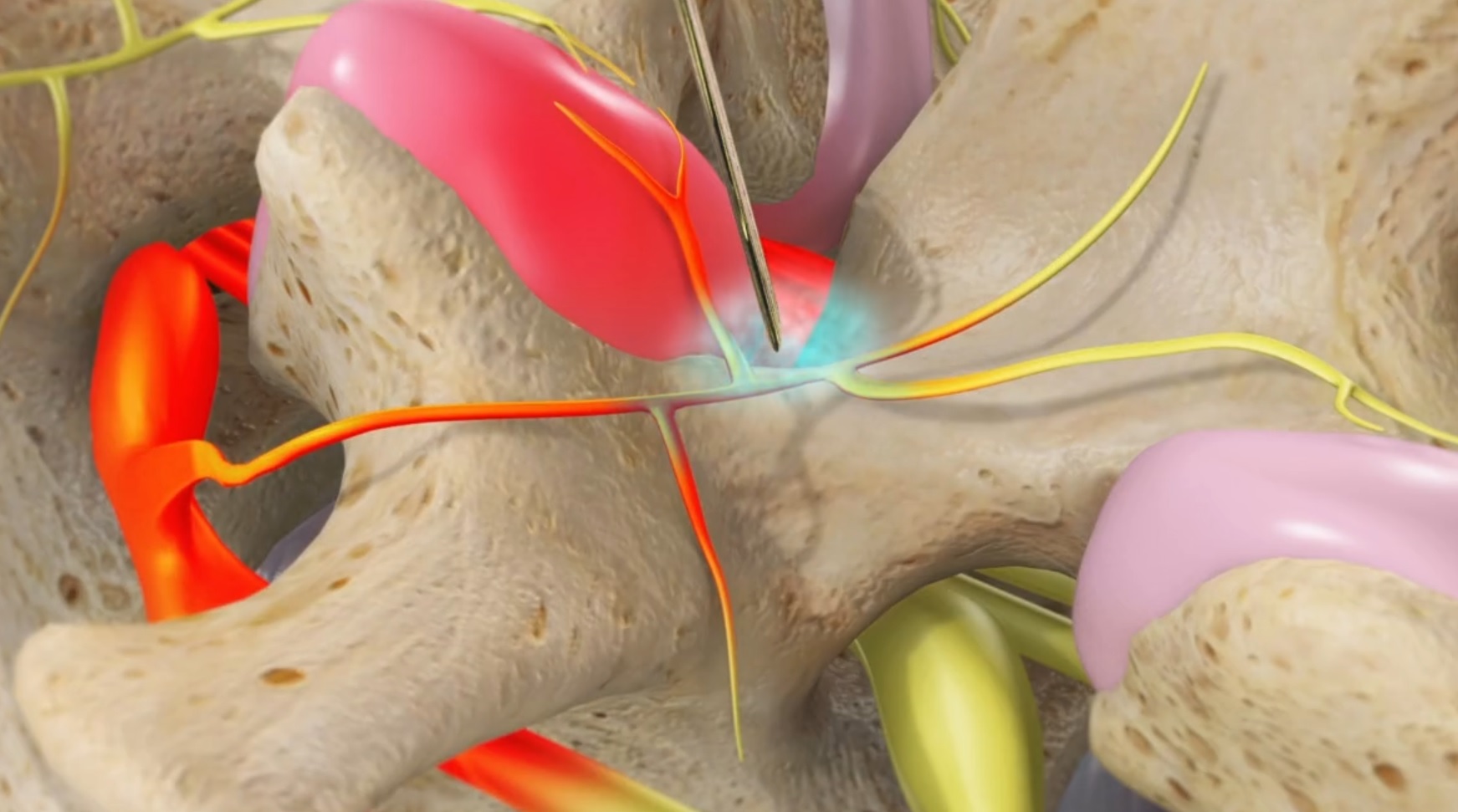 Medial Branch Block