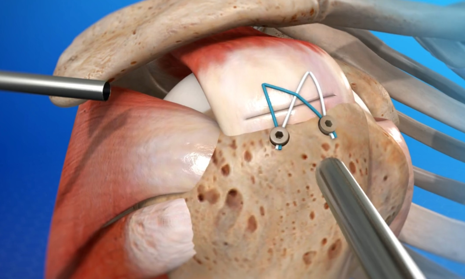 Rotator Cuff Repair Arthroscopic Surgery