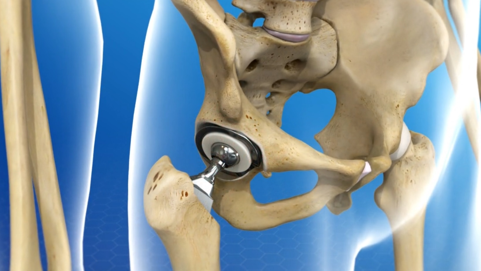 Total Hip Replacement